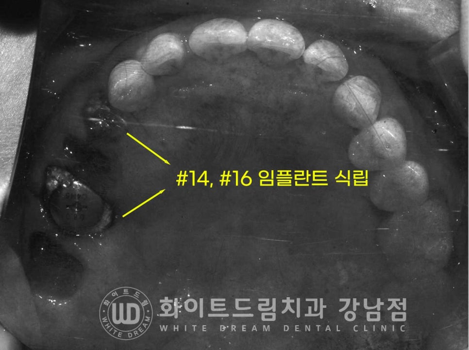 발치 즉시 임플란트 "내원 당일 발치 후 바로 임플란트 식립!" 관련 이미지 10