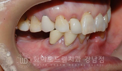 잇몸뼈가 없다는 게 무슨 말일까? "틀니를 오래 사용해서 잇몸뼈가 없대요" 임플란트 잘하는 강남치과 관련 이미지 15