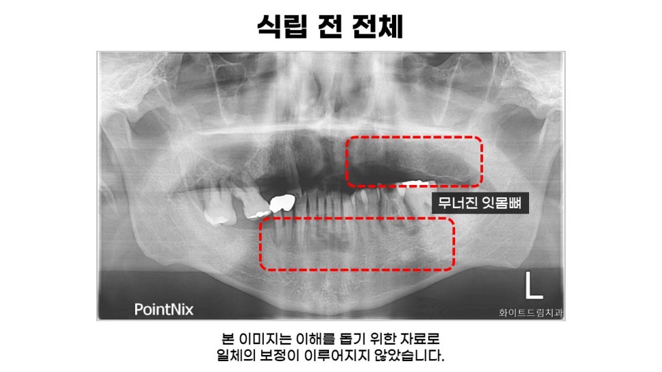 고연령 전체임플란트 과정 및 임플란트 치료기간, 전체임플란트식립후기 관련 이미지 3