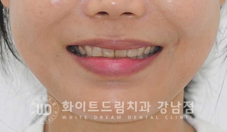 깨진앞니 라미네이트 / 깨지고 누렇게 변한 앞니는? 원데이 라미네이트 치료 사례 관련 이미지 2