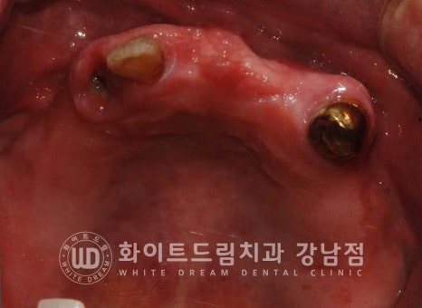 전체 임플란트 치료 기간과 내원 횟수는? "치과에 자주 가기 어려워요." 관련 이미지 6