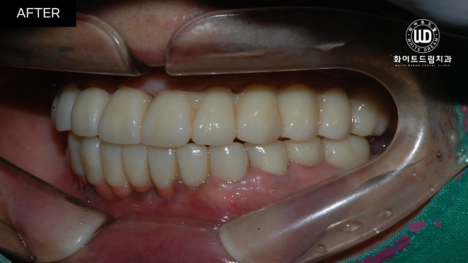 전체임플란트 식립 및 임플란트뼈이식 후기 관련 이미지 10