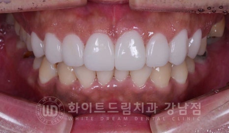 틀어진 치아 라미네이트, 틀어지고 색이 다른 앞니가 고민이에요. 관련 이미지 16