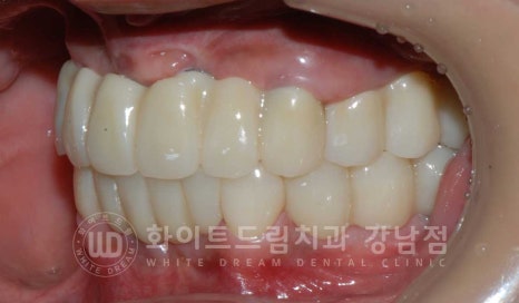 치주염 전체임플란트 치료 사례 / 치아를 흔들리게 만드는 치주염이란? 관련 이미지 18