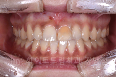 강남역 주변 치과 "10년 된 앞니가 변색됐어요" 앞니 심미 치료 관련 이미지 14