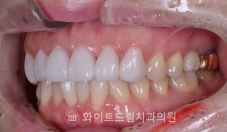 뱅뱅사거리치과 "라미네이트가 마음에 들지 않아요. 하얗고 균일한 치아를 갖고 싶어요." 강남역 화이트드림치과 관련 이미지 12