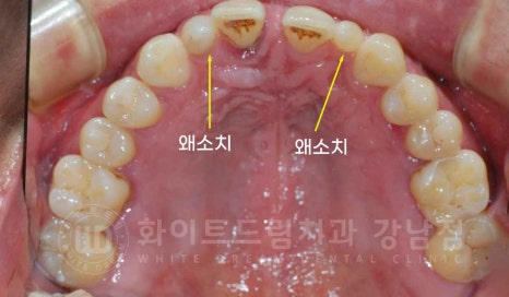 강남역 결손치 "앞니 두 개가 없고, 벌어졌어요" 결손치 치료 방법 관련 이미지 19