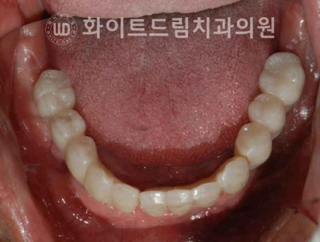서울전체임플란트잘하는치과, 왜 치주염이 심해지면 반대교합까지 생길까요? (치주염 전체 임플란트 CASE) 관련 이미지 20