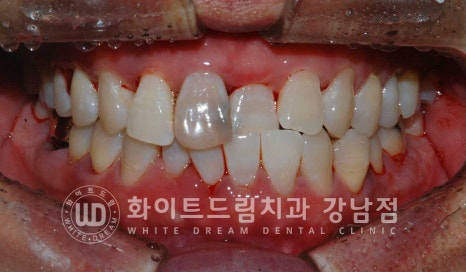 사고당한 앞니치료, "흔들리고 점점 변색돼요." 앞니 임플란트 & 신경치료 관련 이미지 12