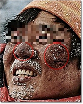 <신촌차앤박피부정보> 겨울철야외활동, 추운 겨울 겪을 수 있는 피부동상에 대해 알아보겠습니다!! 관련 이미지 1