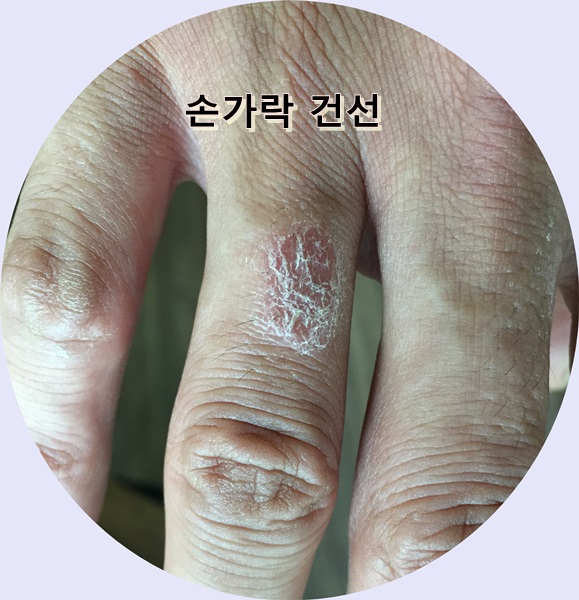 피부 건조 심해지는 겨울에 더욱 악화되는 피부건선...치료할수 있나요?? 관련 이미지 6