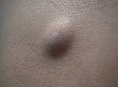 신촌차앤박 피부정보 : 피지낭종(표피낭종) 치료에 대해 알아볼까요? 관련 이미지 2