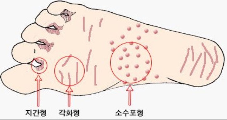 신촌차앤박피부과 피부정보 : 여름피부질환 무좀에 대해 알아볼께요!! 관련 이미지 6