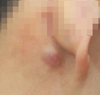 신촌차앤박 피부정보 : 피지낭종(표피낭종) 치료에 대해 알아볼까요? 관련 이미지 1
