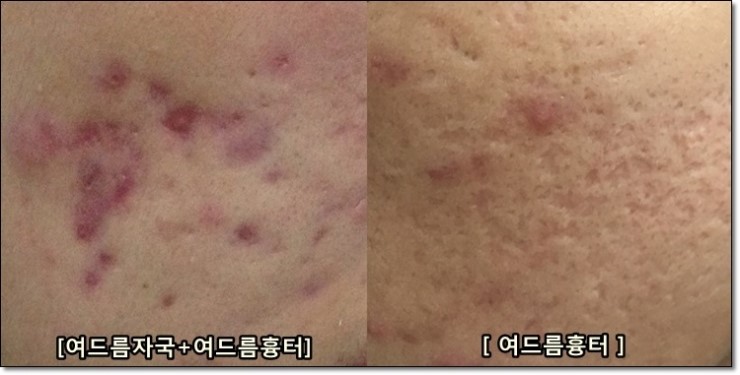 <신촌피부칼럼> 차앤박피부과 신촌점에서 알려드리는 여드름흉터 치료,SDRT로 고민해결!! 관련 이미지 3
