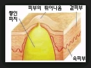 신촌차앤박 피부정보 : 피지낭종(표피낭종) 치료에 대해 알아볼까요? 관련 이미지 3
