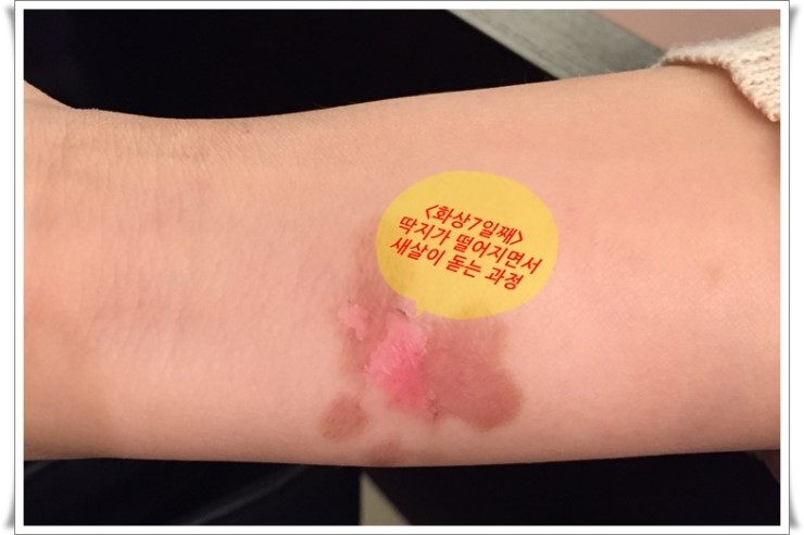 화상물집, 화상치료, 화상흉터를 최소로 남길 수 있는 방법 신촌차앤박에서 알려드릴께요!! 관련 이미지 5