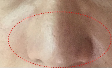 여름 모공 속 피지고민 CNP블랙헤드키트와 안티포어 실러로 해결!! 관련 이미지 3