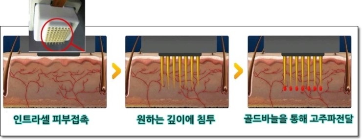무더운 여름 피지와의 전쟁, 포토필로 피지클리어!!. 관련 이미지 4