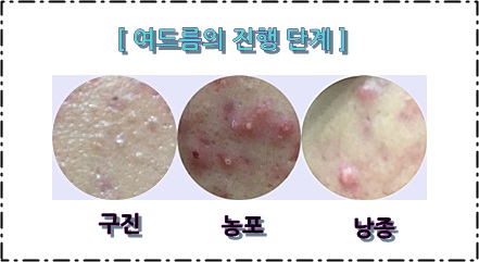 신촌피부칼럼 여름철 피부불청객 여드름치료 관련 이미지 3