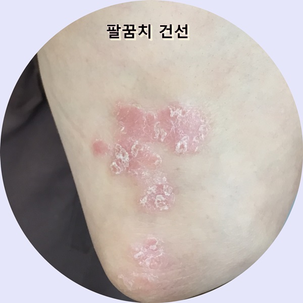 피부 건조 심해지는 겨울에 더욱 악화되는 피부건선...치료할수 있나요?? 관련 이미지 3