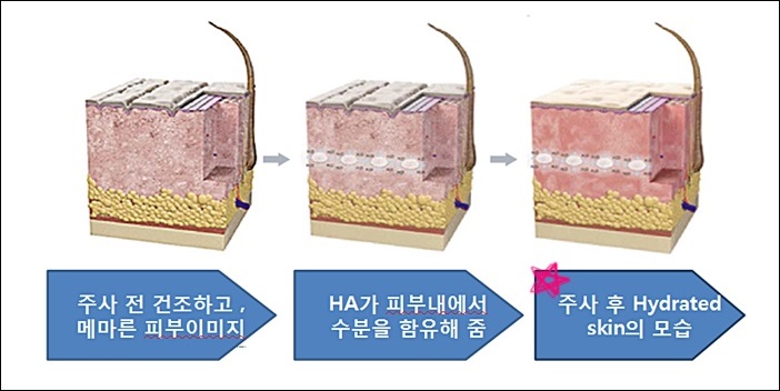 신촌피부과전문의 칼럼:가을철 피부 심폐소생술 CNP하이드로업UP 관련 이미지 3