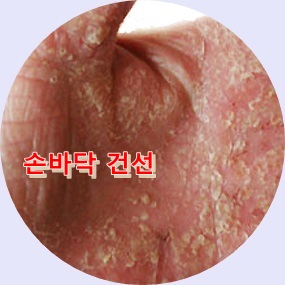 피부 건조 심해지는 겨울에 더욱 악화되는 피부건선...치료할수 있나요?? 관련 이미지 5