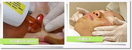 신촌피부칼럼 여름철 피부불청객 여드름치료 관련 이미지 5