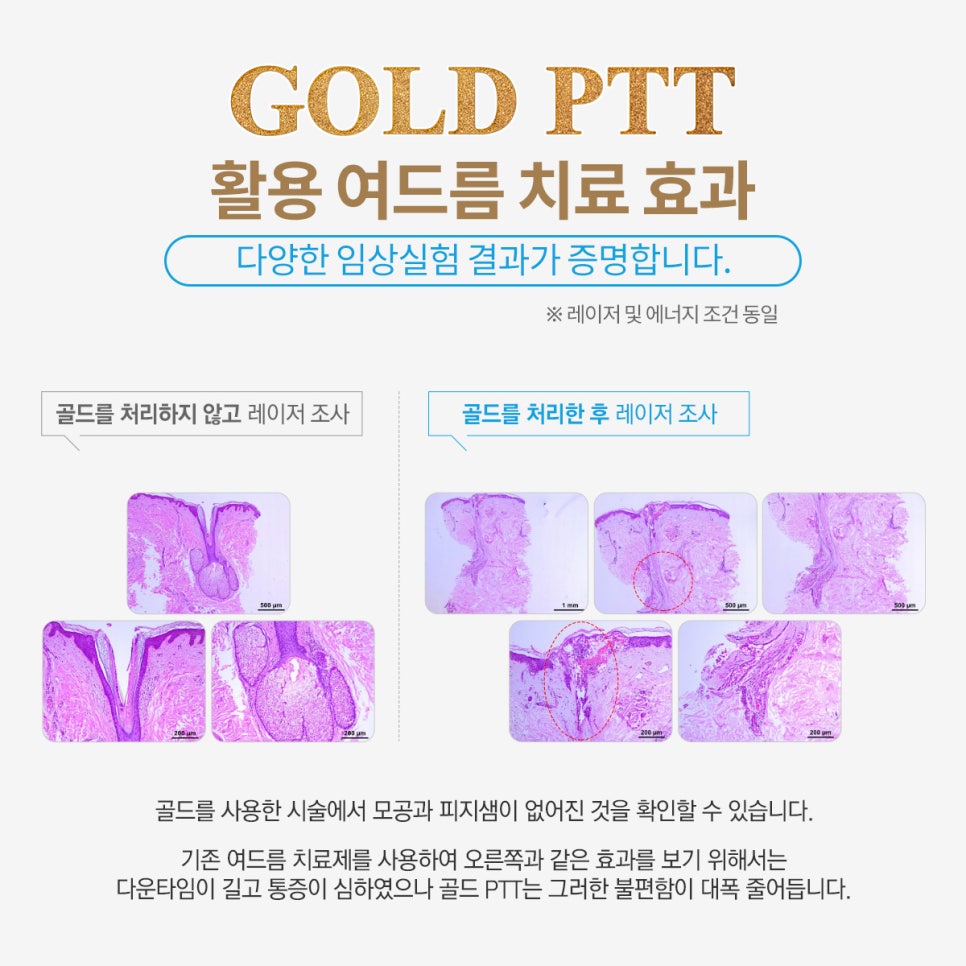 신촌차앤박 피부 칼럼 : GOLD PTT ~!!! 관련 이미지 9