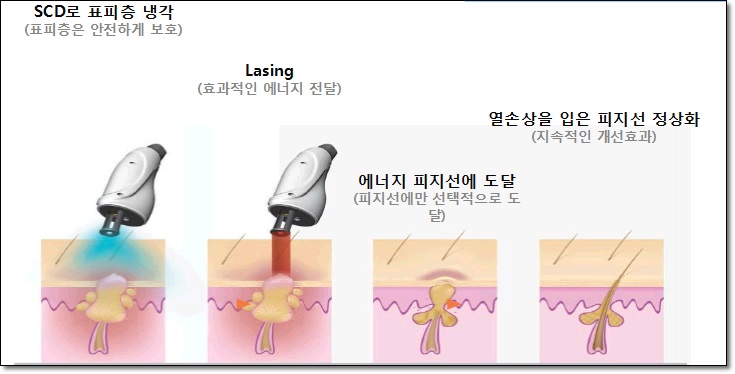 <신촌피부칼럼> 봄철피부관리 1탄 : 봄,환절기 여드름치료 관련 이미지 2
