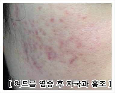 <신촌피부전문의칼럼> 시도 때도 없이 빨개지는 안면홍조...혈관레이저 치료 받고 탈출!! 관련 이미지 5