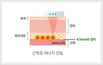 신촌피부과전문의칼럼:미세먼지로 인한 피부노화 치료 관련 이미지 3
