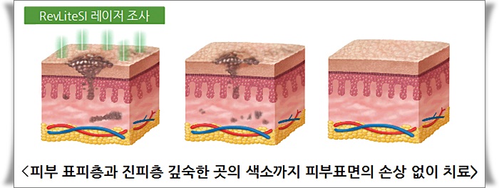 신촌피부칼럼: 기미,주근깨,잡티제거 신개념 레블라이트SI 시술 관련 이미지 2