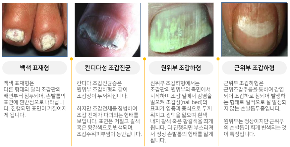 신촌차앤박 피부 칼럼 : 손,발톱 무좀 치료하는 관련 이미지 3