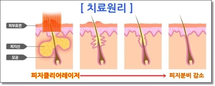 무더운 여름 피지와의 전쟁, 포토필로 피지클리어!!. 관련 이미지 2