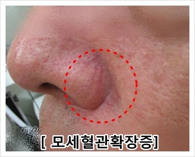 <신촌피부전문의칼럼> 시도 때도 없이 빨개지는 안면홍조...혈관레이저 치료 받고 탈출!! 관련 이미지 4