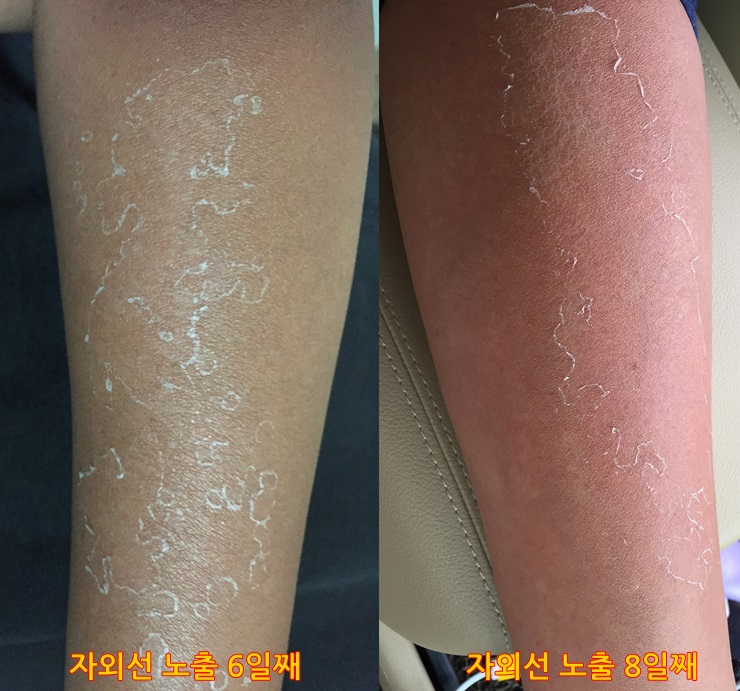 신촌차앤박피부과 피부정보 : 자외선에 의한 피부문제, 일광화상에 대해 알아보아요!! 관련 이미지 6