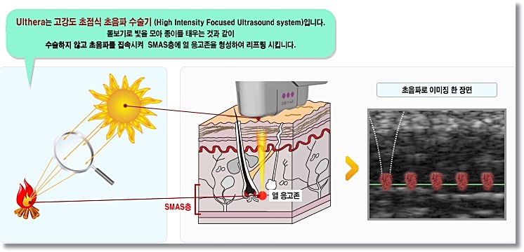 신촌피부전문의 피부칼럼 : 추석연휴4일의 기적,젊은층은 매끈하게,장년층은 회춘동안피부 만들기 관련 이미지 3