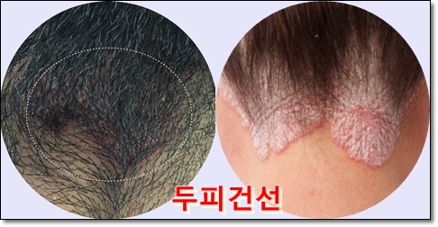 피부 건조 심해지는 겨울에 더욱 악화되는 피부건선...치료할수 있나요?? 관련 이미지 2