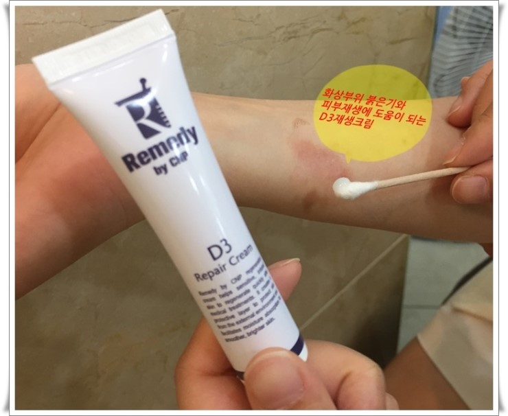 화상물집, 화상치료, 화상흉터를 최소로 남길 수 있는 방법 신촌차앤박에서 알려드릴께요!! 관련 이미지 4
