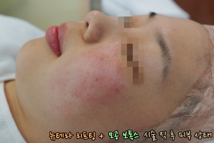 [공유] 남는 것은 사진! 활짝 웃어 보세요~ 뉴테라 리프팅으로 피부 탄력, 넓은 모공 개선하기! 관련 이미지 9