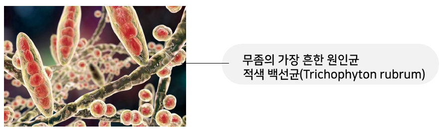 신촌차앤박 피부 칼럼 : 손,발톱 무좀 치료하는 관련 이미지 2