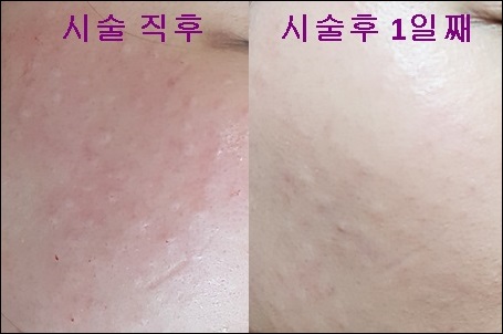 신촌피부과전문의 칼럼:가을철 피부 심폐소생술 CNP하이드로업UP 관련 이미지 4