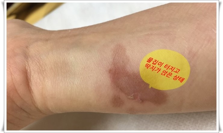 화상물집, 화상치료, 화상흉터를 최소로 남길 수 있는 방법 신촌차앤박에서 알려드릴께요!! 관련 이미지 2