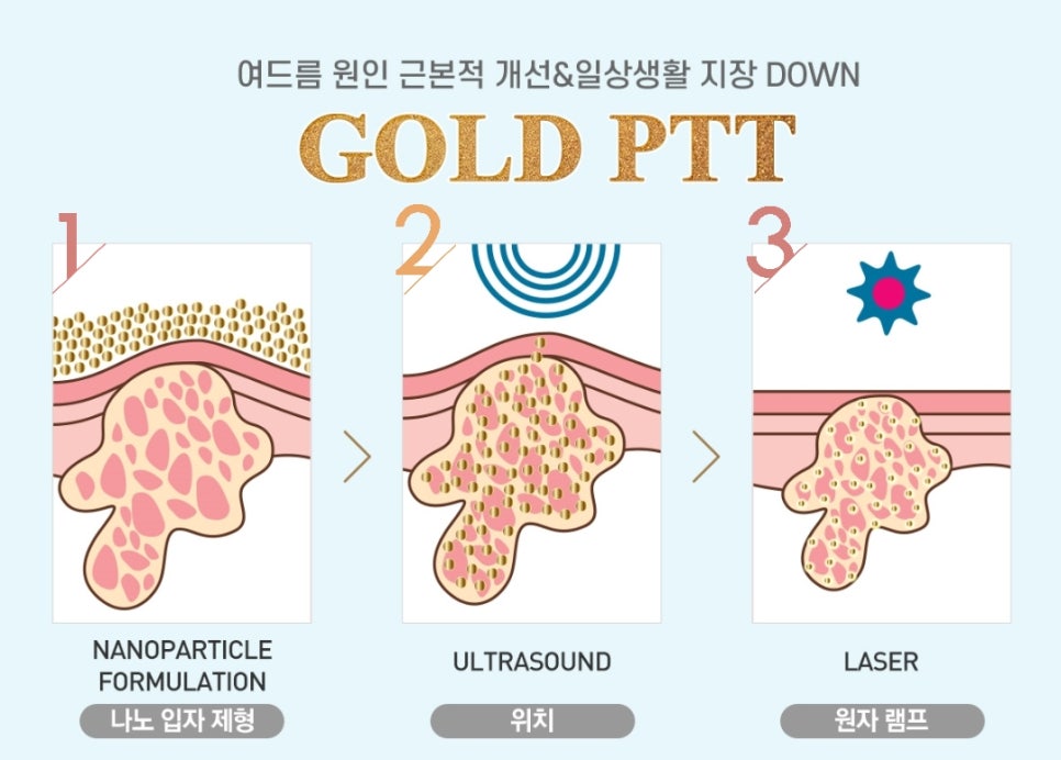신촌차앤박 피부 칼럼 : GOLD PTT ~!!! 관련 이미지 5