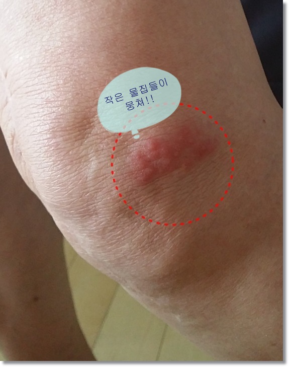 여름철 기승 부리는 대상포진, 증상과 치료에 대해 알아보아요!! 관련 이미지 1