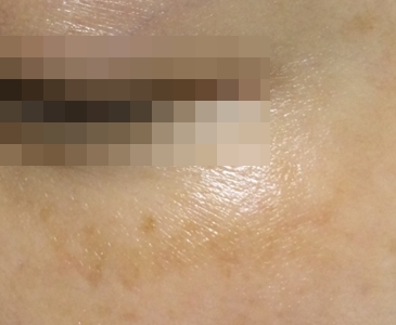 [공유] 가을은 화이트닝의 계절, 여름내 진해진 기미 치료를 위한 방법을 찾아보자! 관련 이미지 2