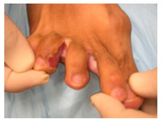 신촌차앤박피부과 피부정보 : 여름피부질환 무좀에 대해 알아볼께요!! 관련 이미지 5