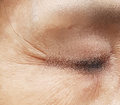 신촌피부전문의칼럼:봄철 눈가주름, 리쥬란아이 시술로 고민 끝!! 관련 이미지 2