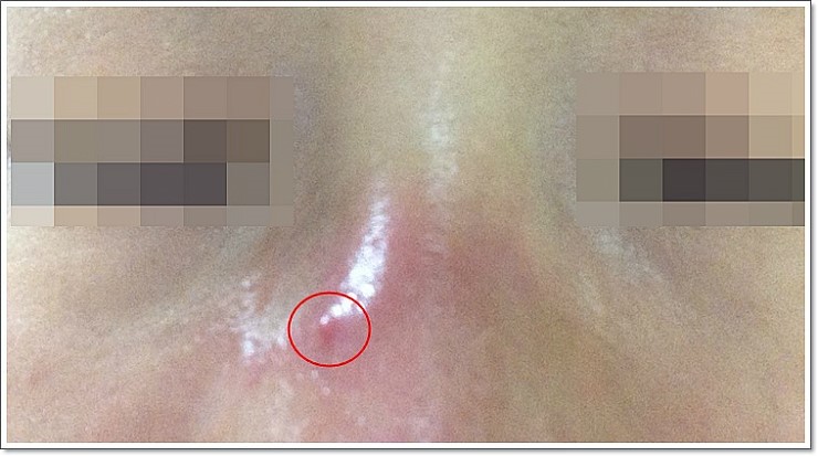 신촌차앤박피부과 피부정보 : 오늘은 종기에 대해 알아보아요!! 관련 이미지 1